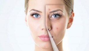 جای جوش را چگونه از بین ببریم